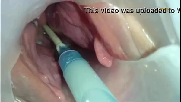 Yeni Sperm injected into the uterus of the wife of others klip Tube