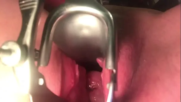 Tabung klip Cervix stretched and sounded segar