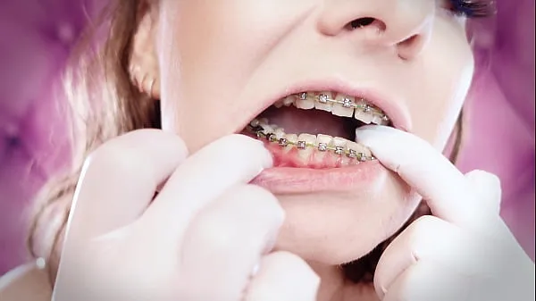 Nuevos ASMR: upgraded braces with chain-link rubber bands and nitrile gloves (Arya Grander clips de tubo